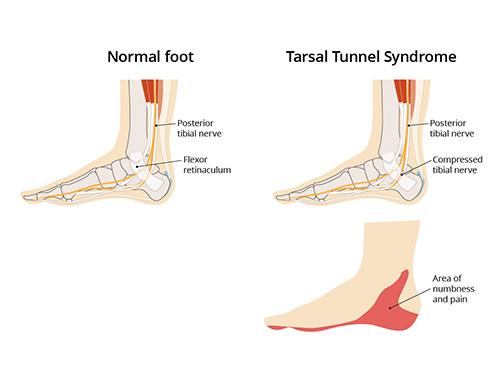Tarsal Tunnel Syndrome Tts A View To The Foot And Its Nerves