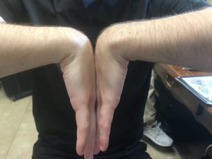 Carpal Tunnel Syndrome
