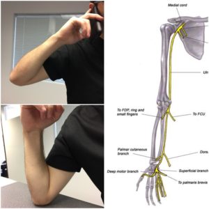 Cubital Tunnel Syndrome