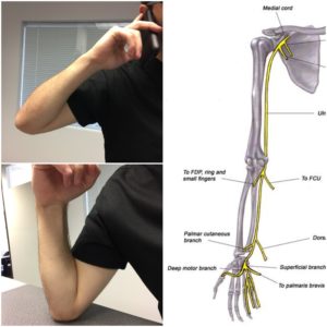 Ulnar Nerve Entrapment, Cubital Tunnel Syndrome, Elbow Specialists