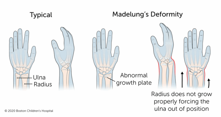 Madelung’s Deformity