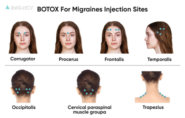 Botox Works for Migraines