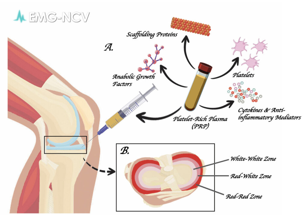 PRP Treatment in Encino for Soft Tissue Damage- Is It Right for You?